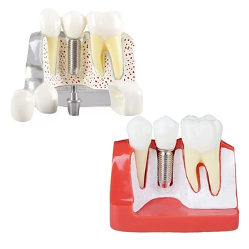 Демонстрационная модель имплантата для НОВЫХ зубов, съемная коронка для анализа, мостовидный протез для общения с пациентом 0