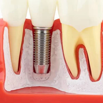 Демонстрационная модель имплантата для НОВЫХ зубов, съемная коронка для анализа, мостовидный протез для общения с пациентом 1