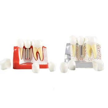 Демонстрационная модель имплантата для НОВЫХ зубов, съемная коронка для анализа, мостовидный протез для общения с пациентом 3