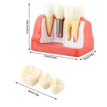 Демонстрационная модель имплантата для НОВЫХ зубов, съемная коронка для анализа, мостовидный протез для общения с пациентом 4