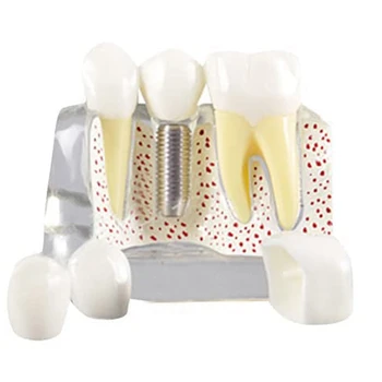 Демонстрационная модель имплантата для НОВЫХ зубов, съемная коронка для анализа, мостовидный протез для общения с пациентом 5